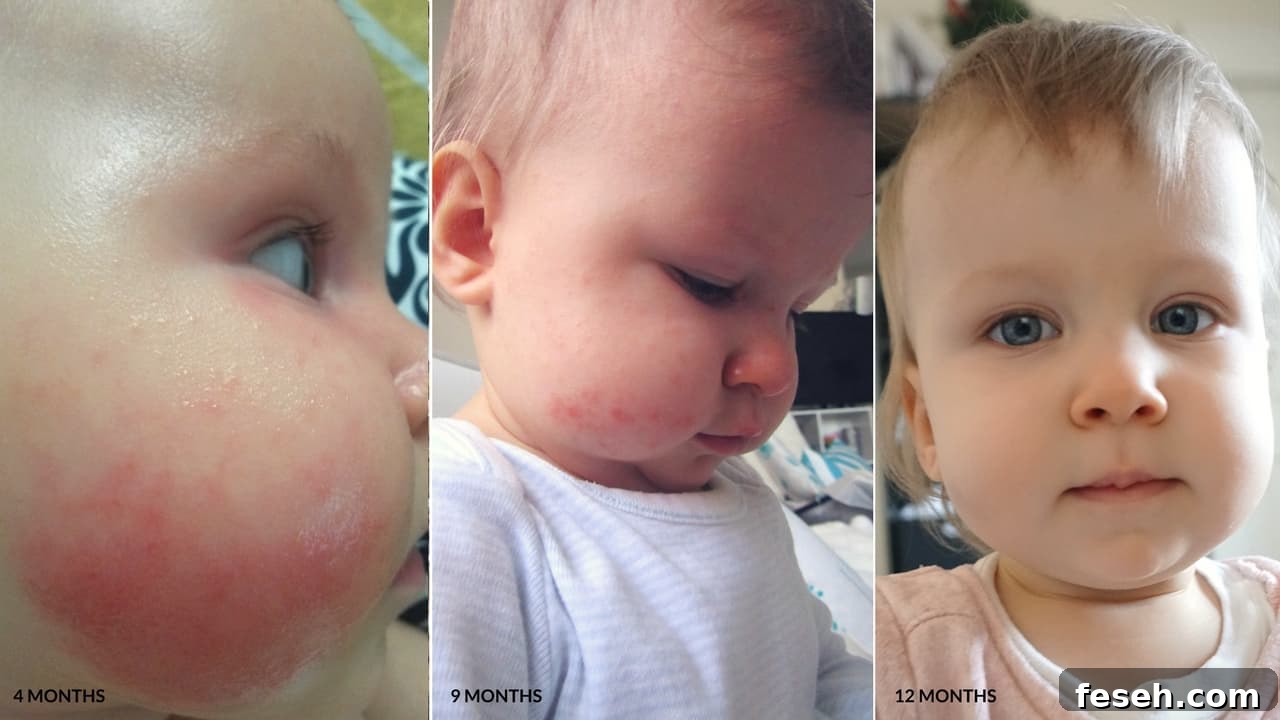Healthy Homemade Baby Food Ideas, Get Rid Of Allergies And Eczema